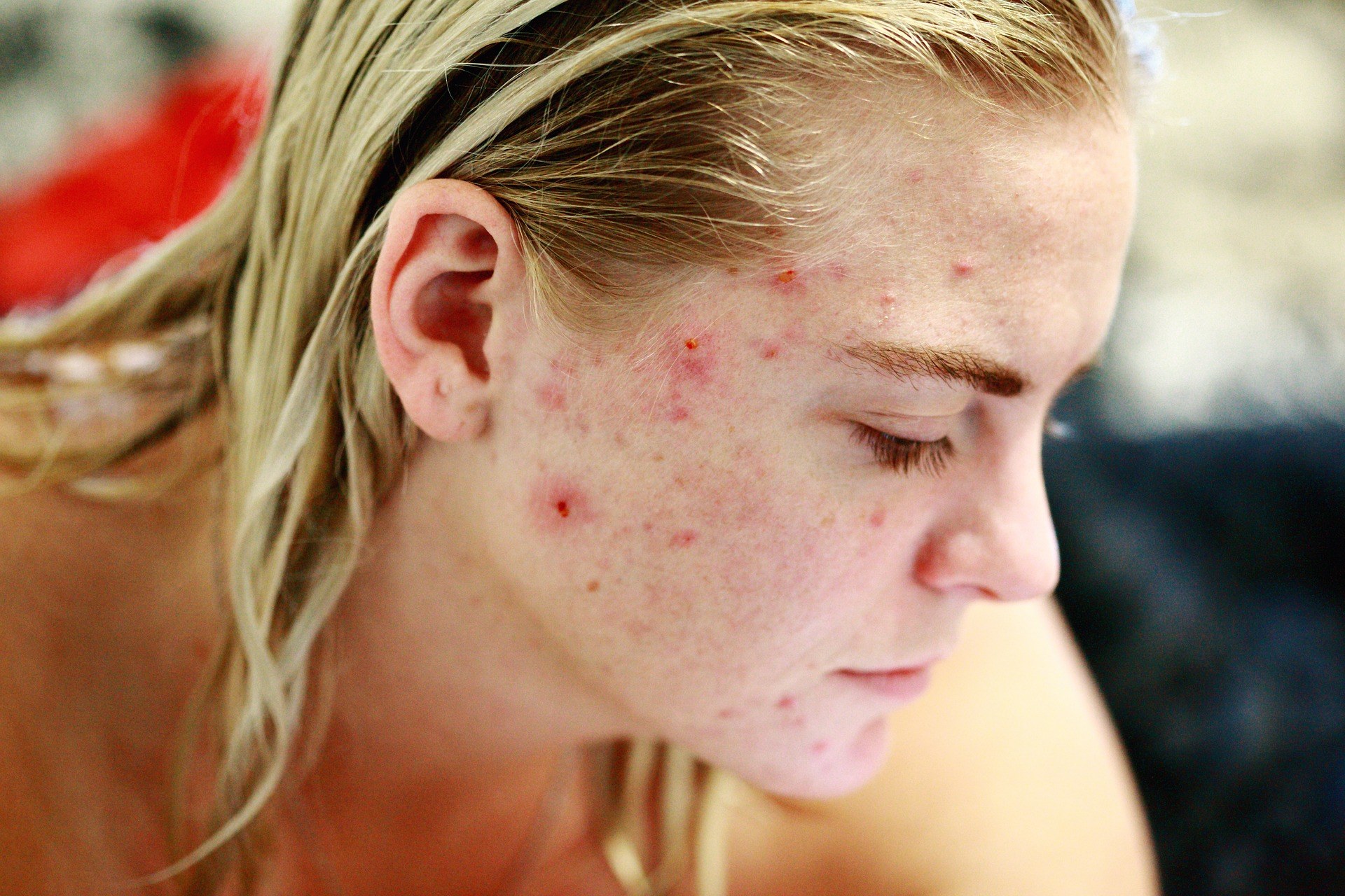 acne-ipl-skins-epilation-montreal