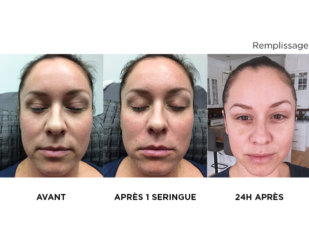 injectables-skins-montreal