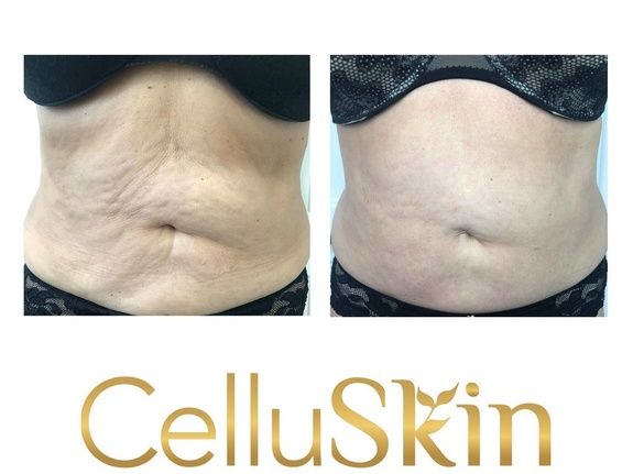 CelluSkin5